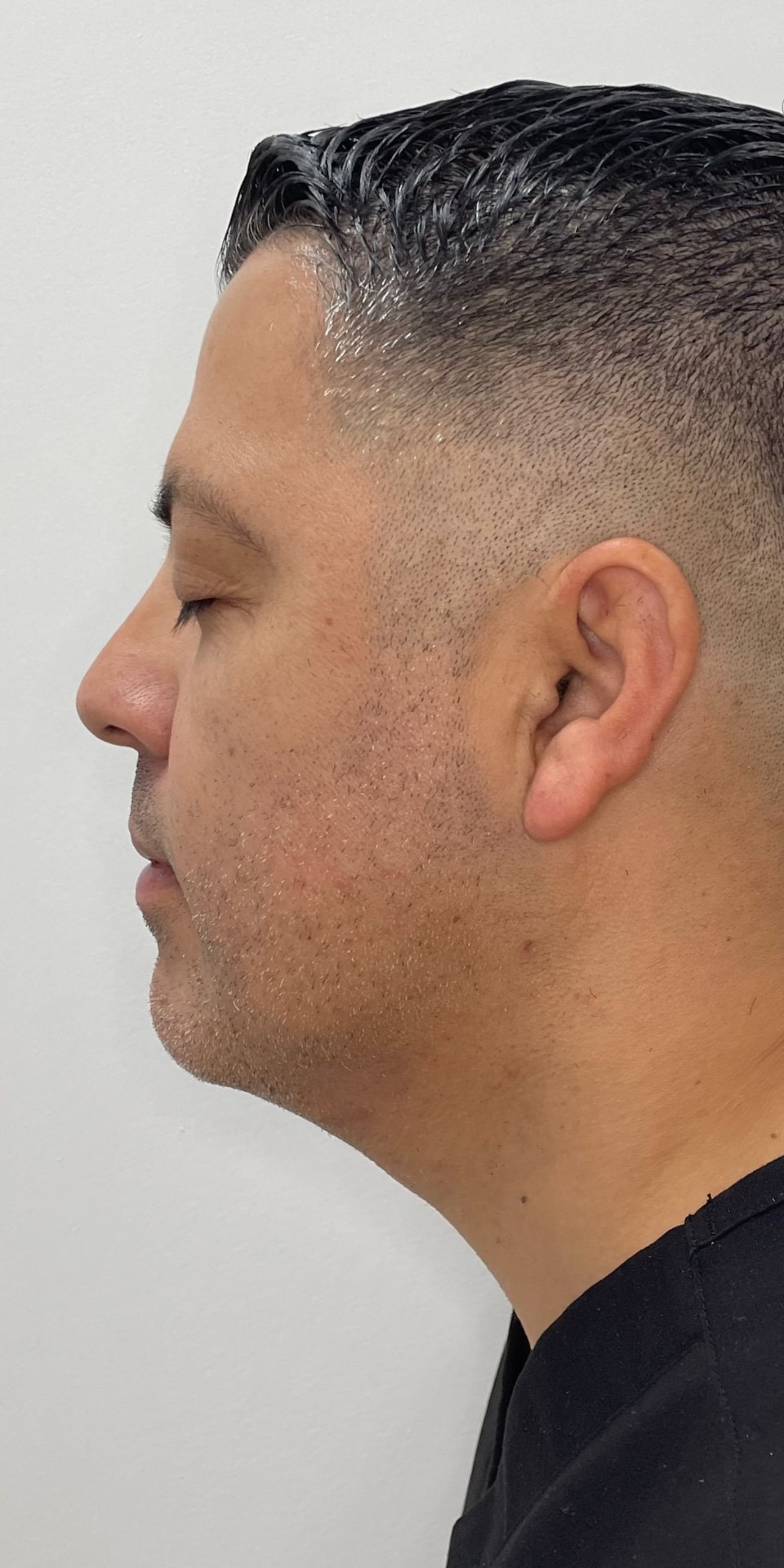 Chin Liposuction result — after