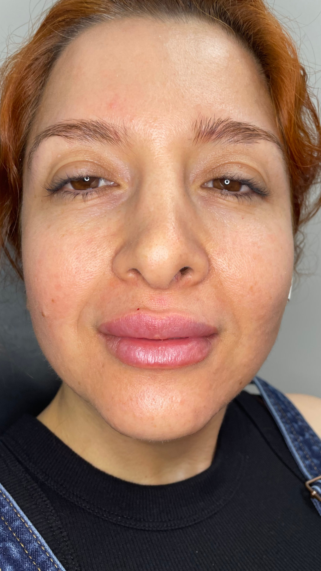 Lip Filler result — after