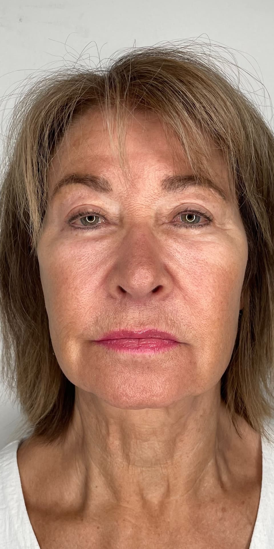 EndoLift result — after