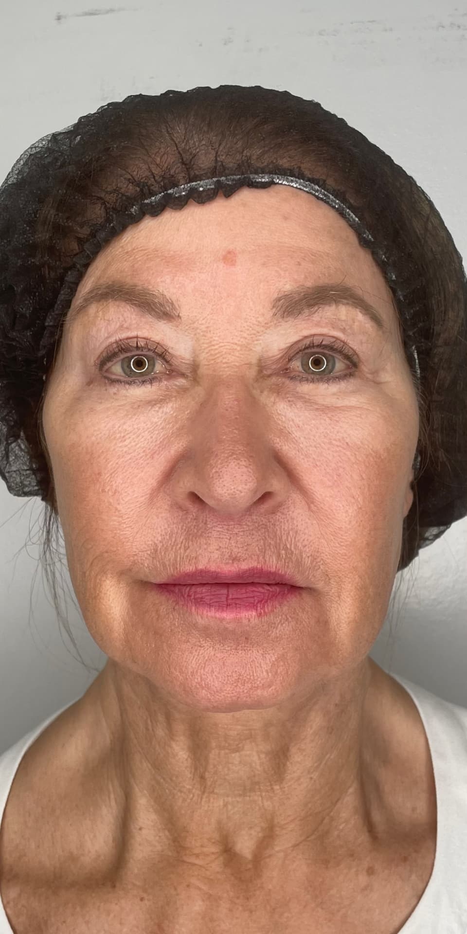 EndoLift result — before